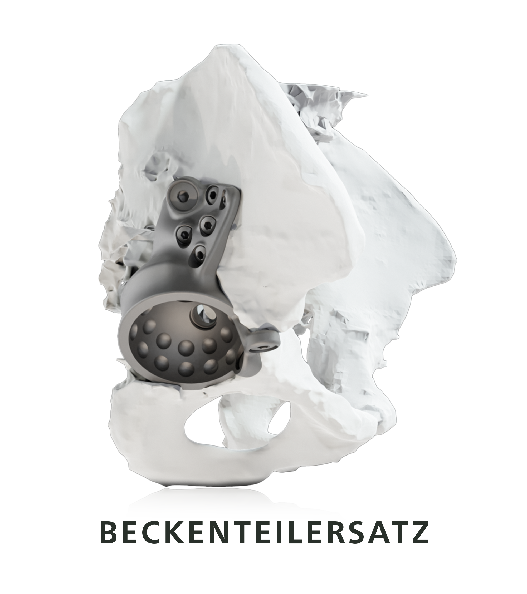Individualprothese, Revisionspfanne im Beckenmodell