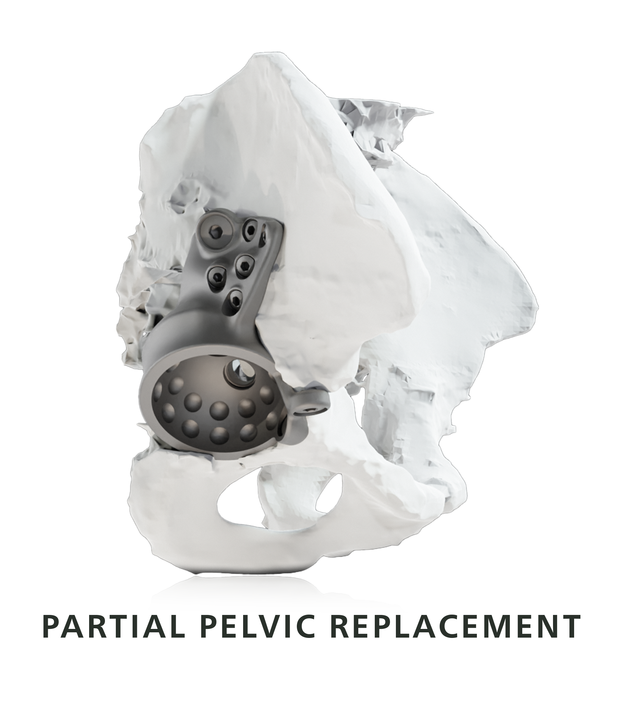 Example for custom made implant for partial pelvic replacement