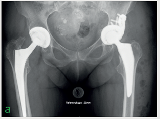 Röntgenaufnahme zur postoperativen Kontrolle nach Einsatz der MRS-Titan Standard /Maximum